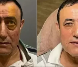 Mahmut Tuncer’i 10 yaş gençleştiren operasyonun detayları